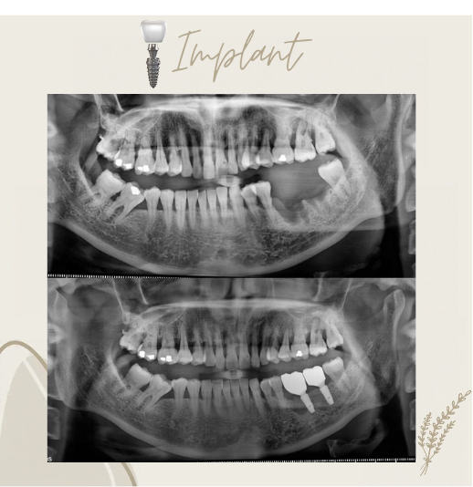 Dental implant before and after smile comparison, case 3