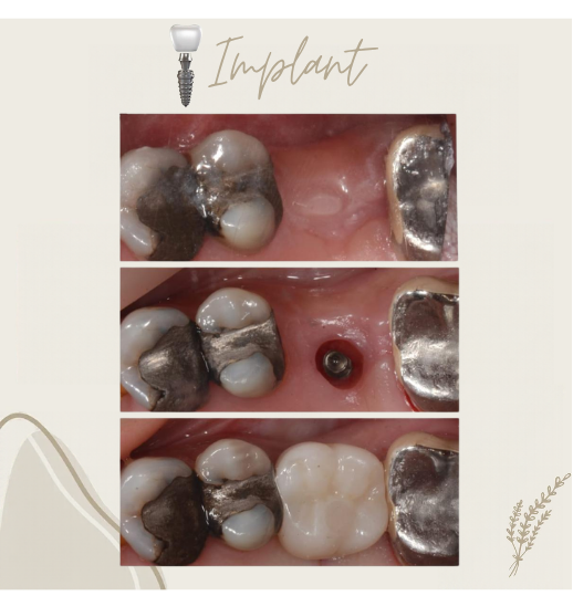 Dental implant before and after smile comparison, case 4