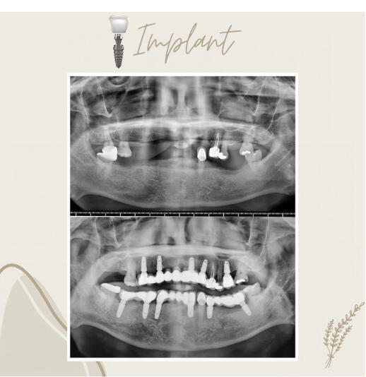 Dental implant before and after smile comparison, case 5