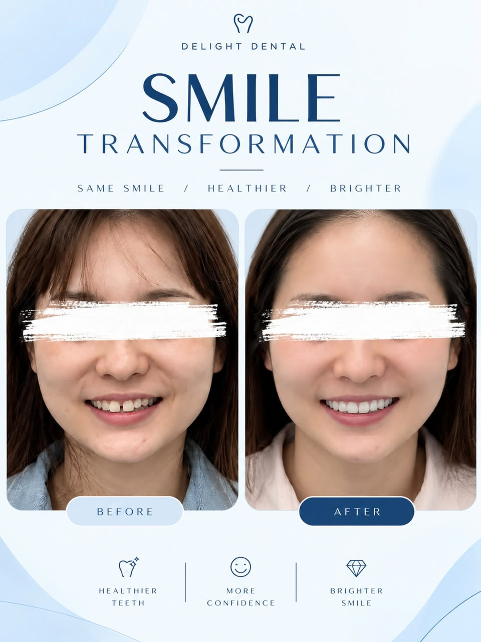 Invisalign before and after smile comparison, new case 1