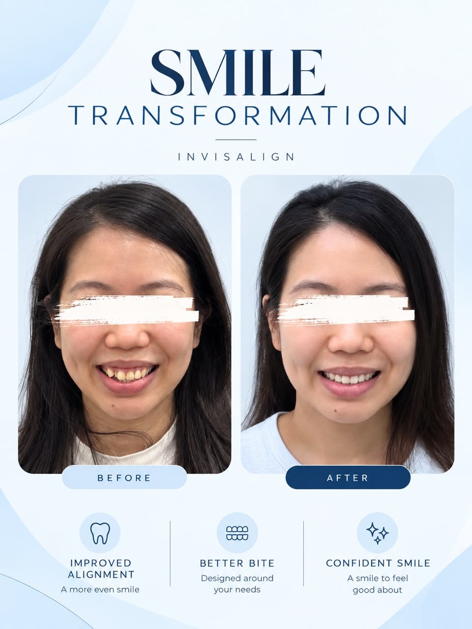 Invisalign before and after smile comparison, new case 2