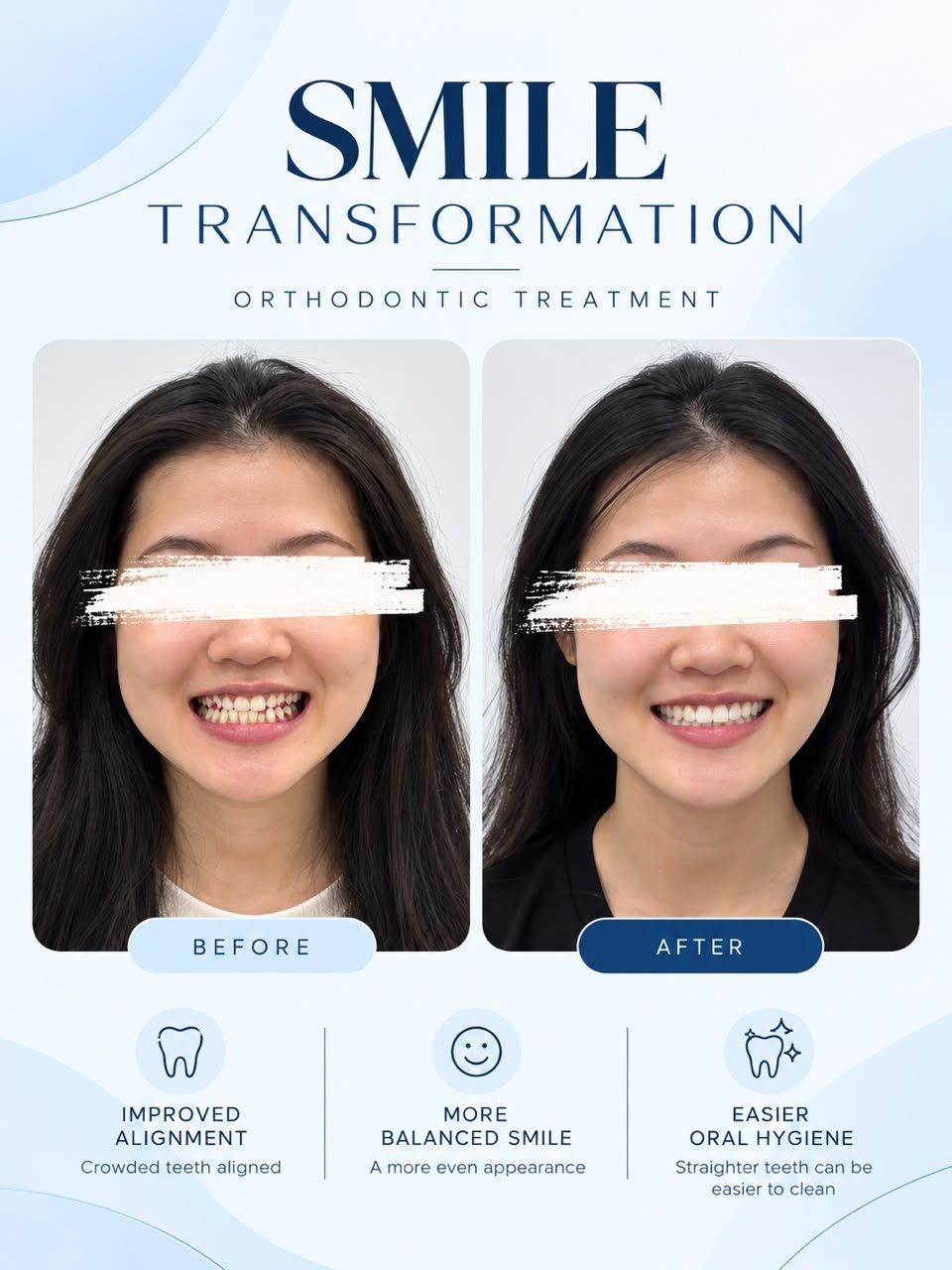 Invisalign before and after smile comparison, new case 3