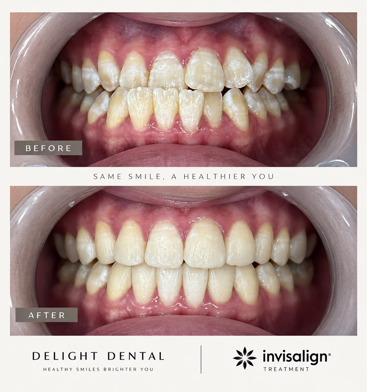 Invisalign before and after smile comparison, new case 4