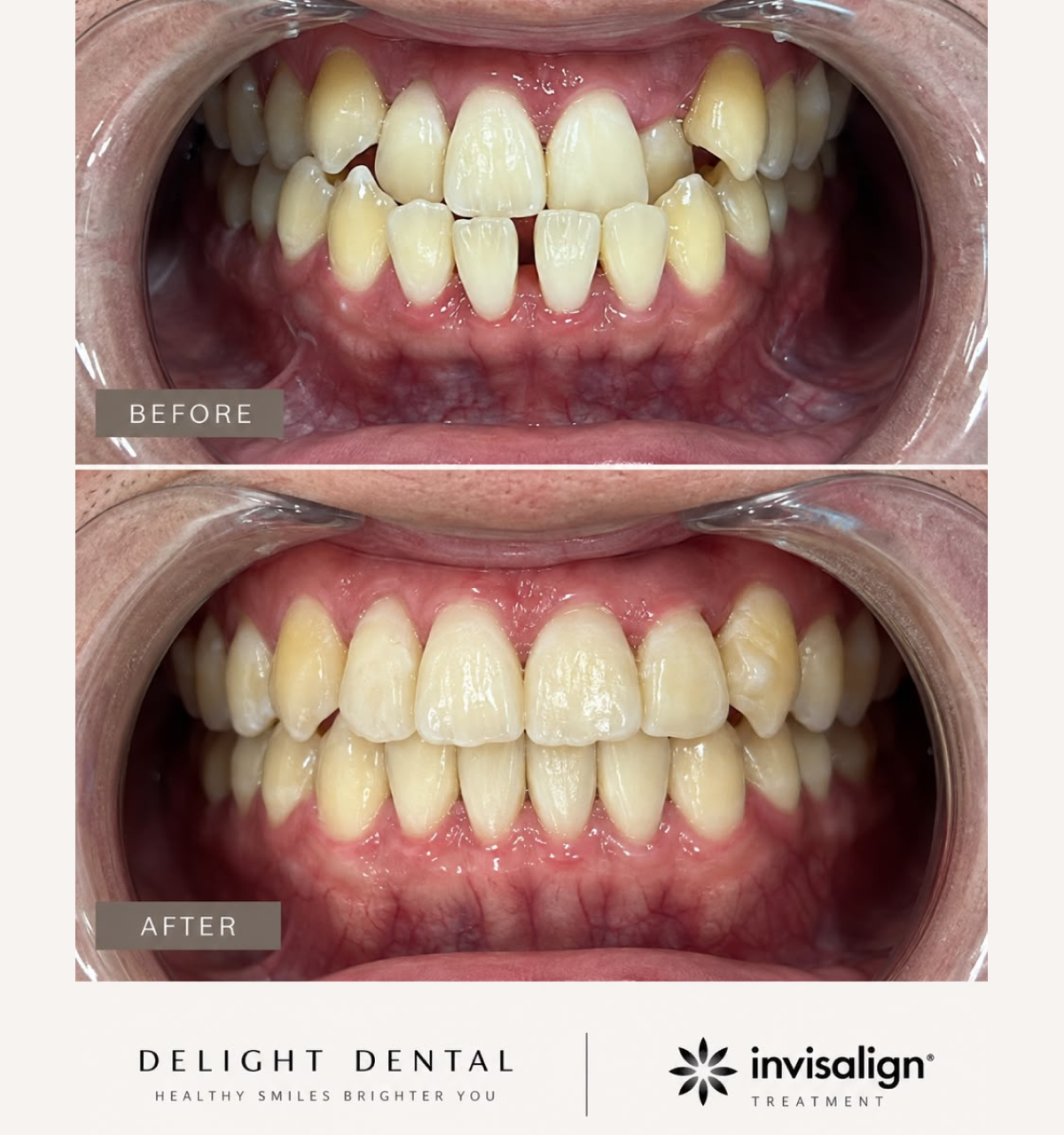 Invisalign before and after smile comparison, new case 5