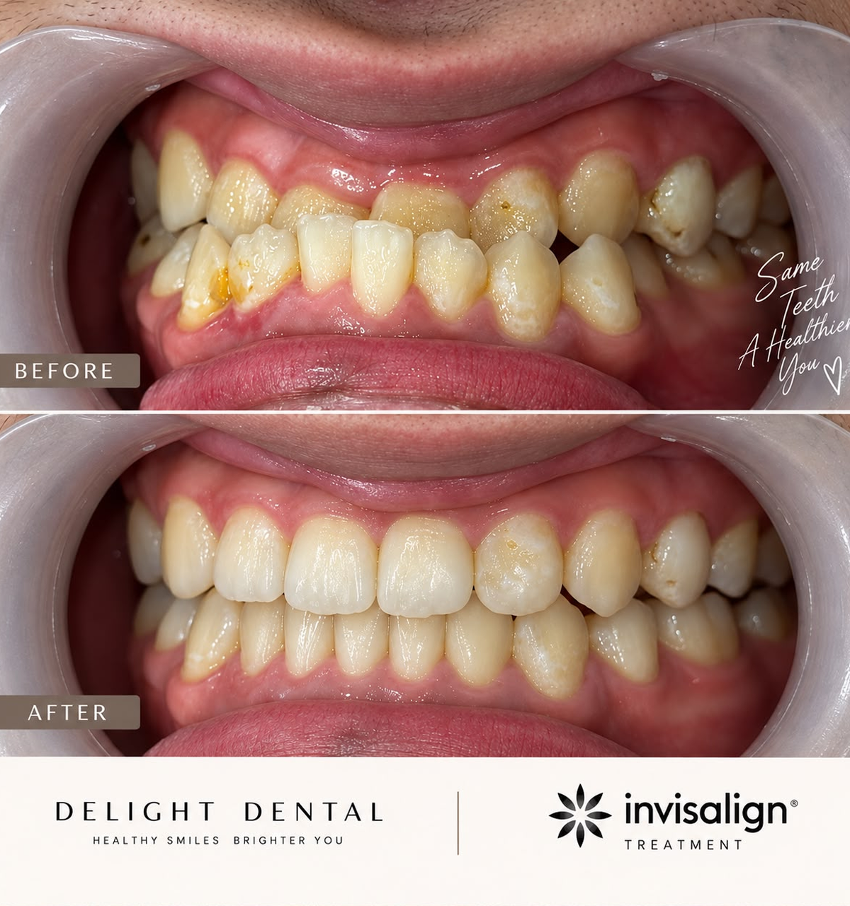 Invisalign before and after smile comparison, new case 6