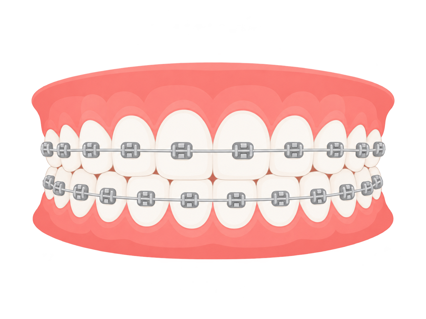 Metal Braces