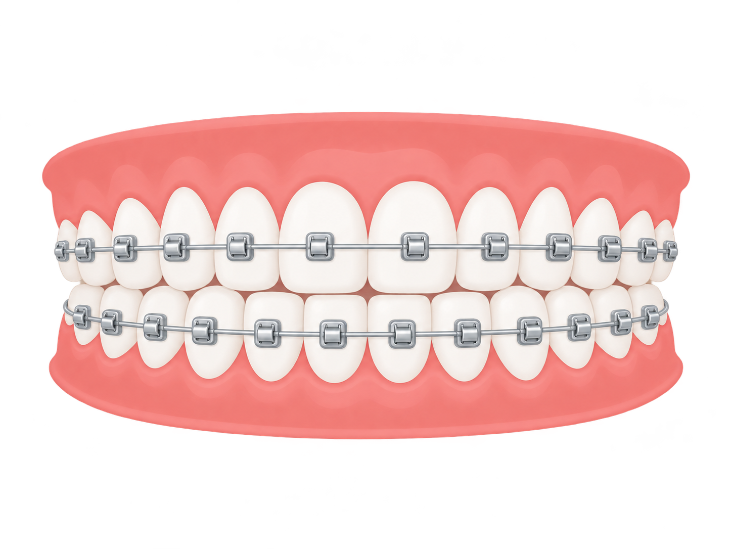 Self-Ligating Braces