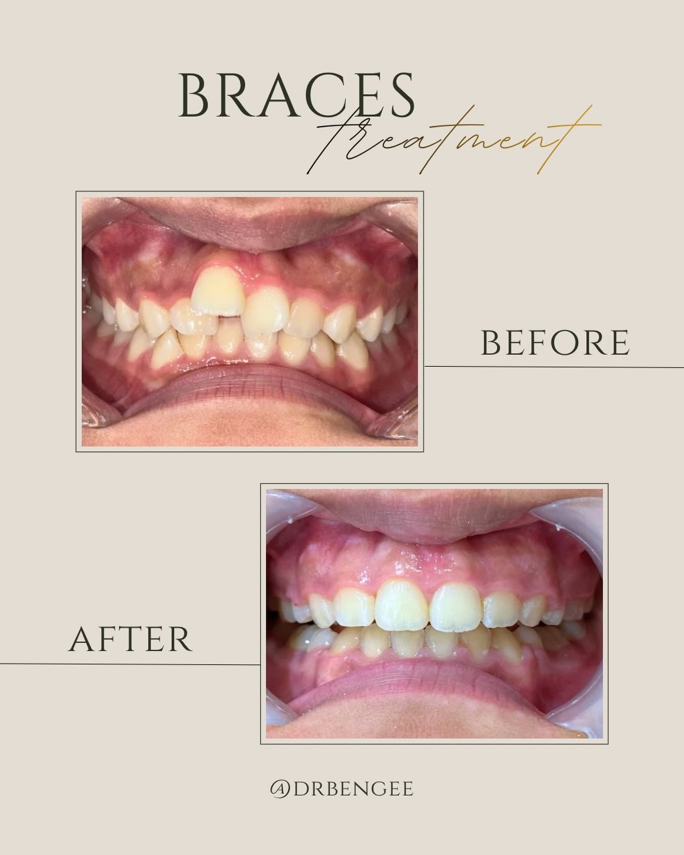Braces before and after comparison, case 3