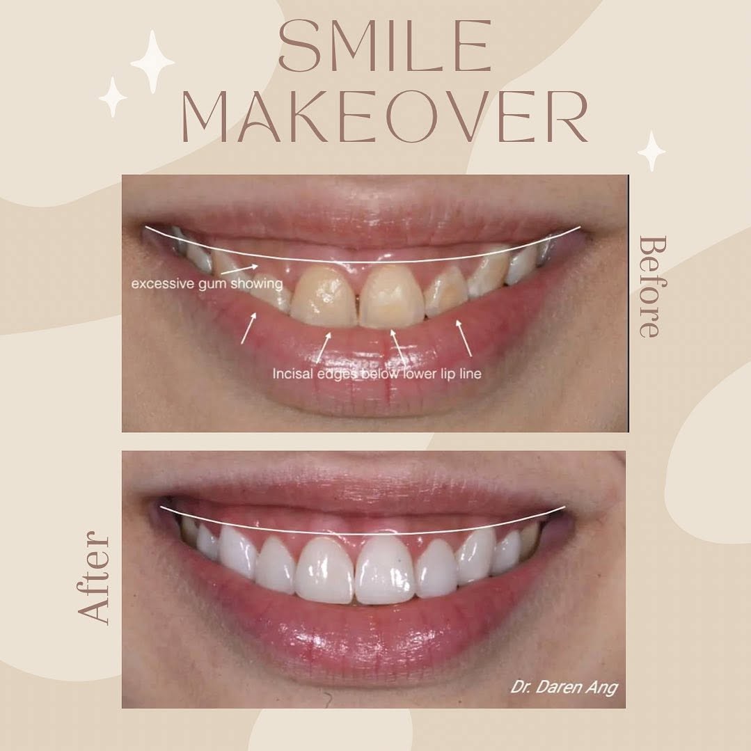 Dental veneer before and after comparison, case 2