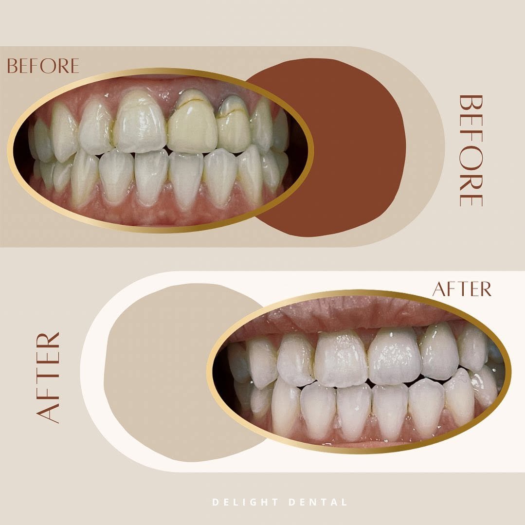 Dental veneer before and after comparison, case 3