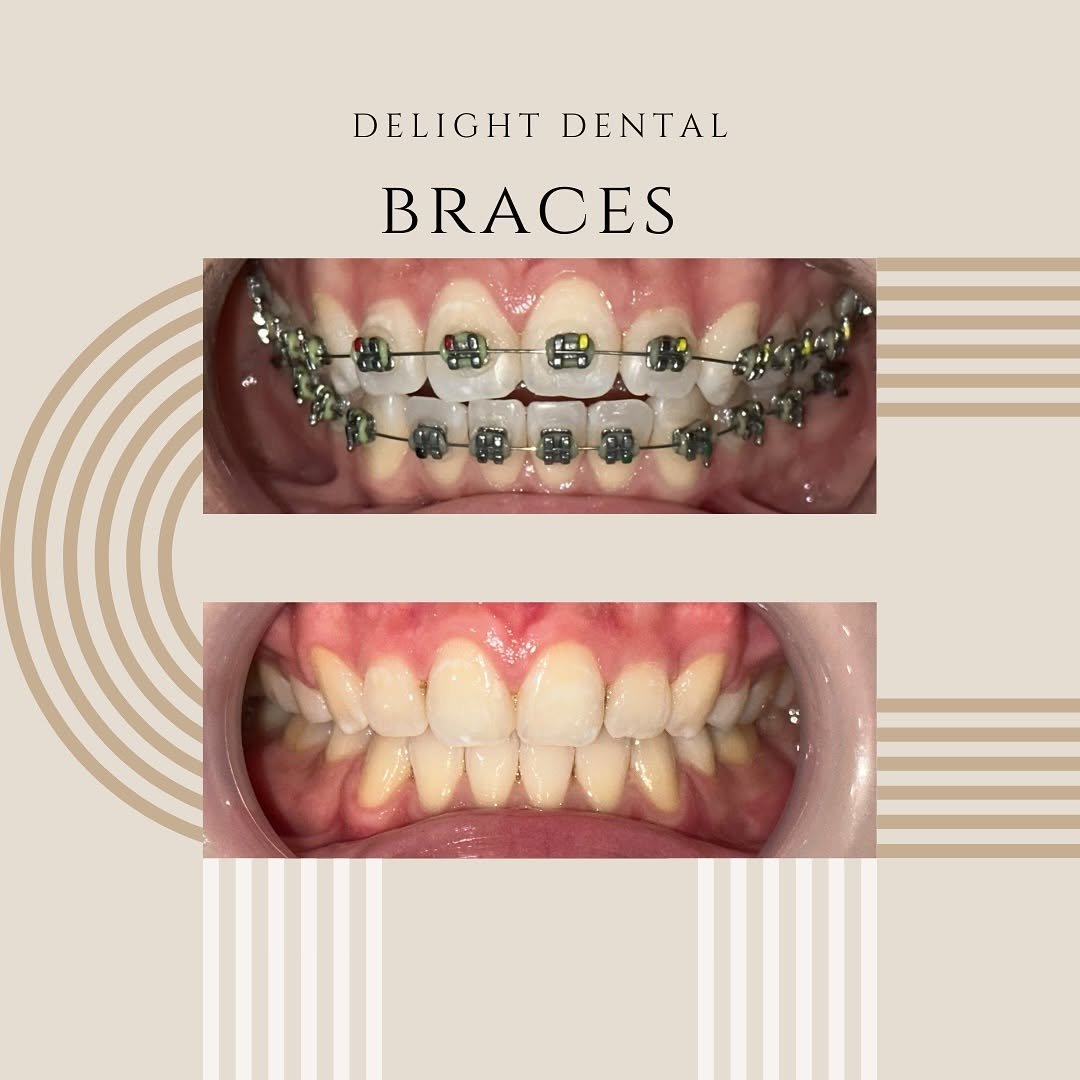 braces before after