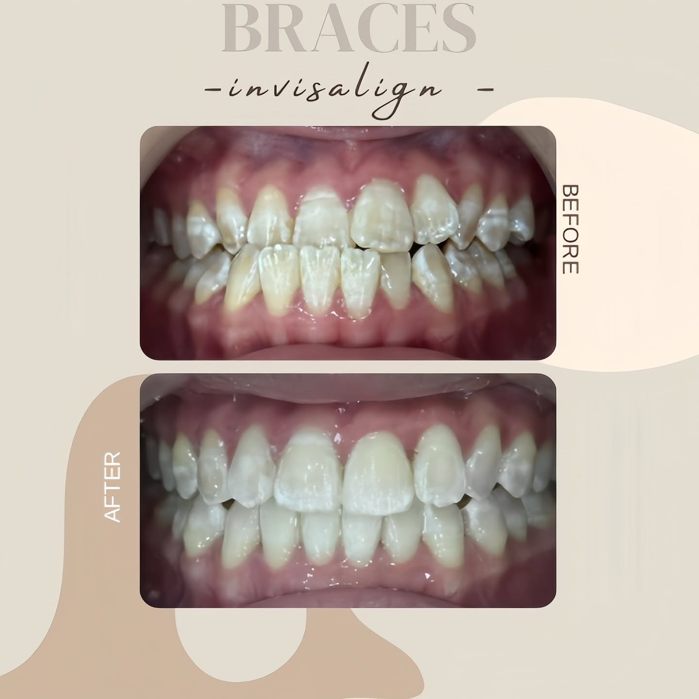 Invisalign before and after smile comparison, case 1