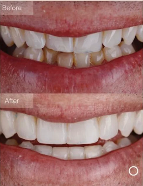 Invisalign Comprehensive treatment package illustration