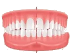 Crossbite teeth and bite illustration