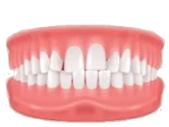 Crowding teeth and bite illustration