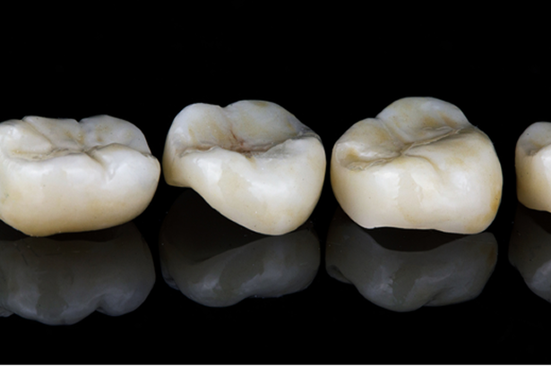 Crowns & Bridges treatment