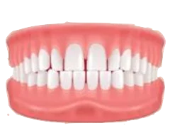 Excessive Spacing teeth and bite illustration
