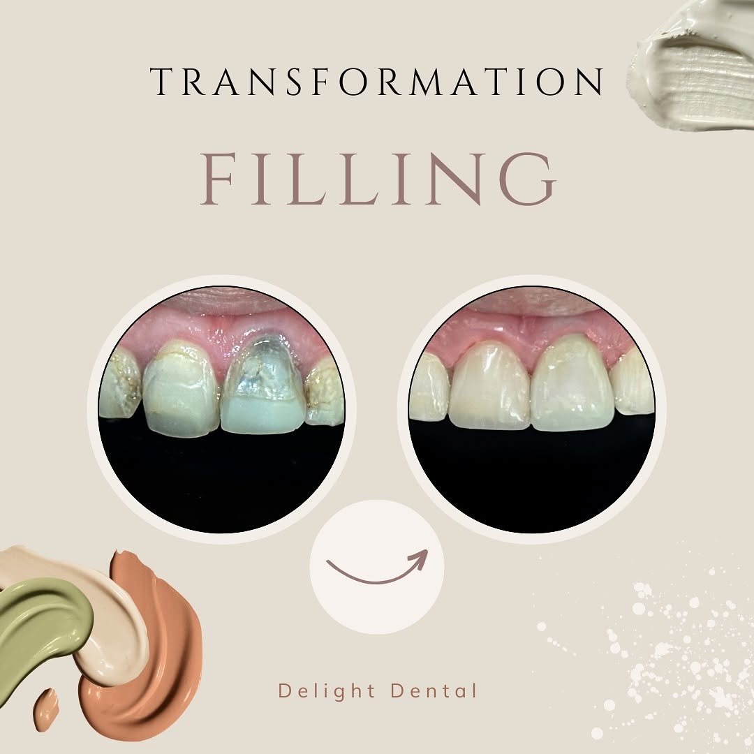 filling before after 3