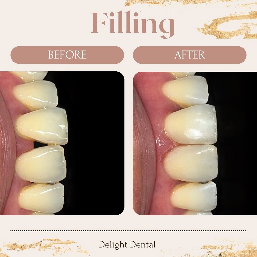 filling before after