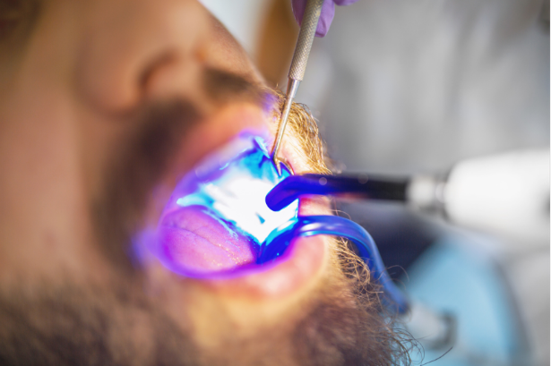 Dental Fillings treatment