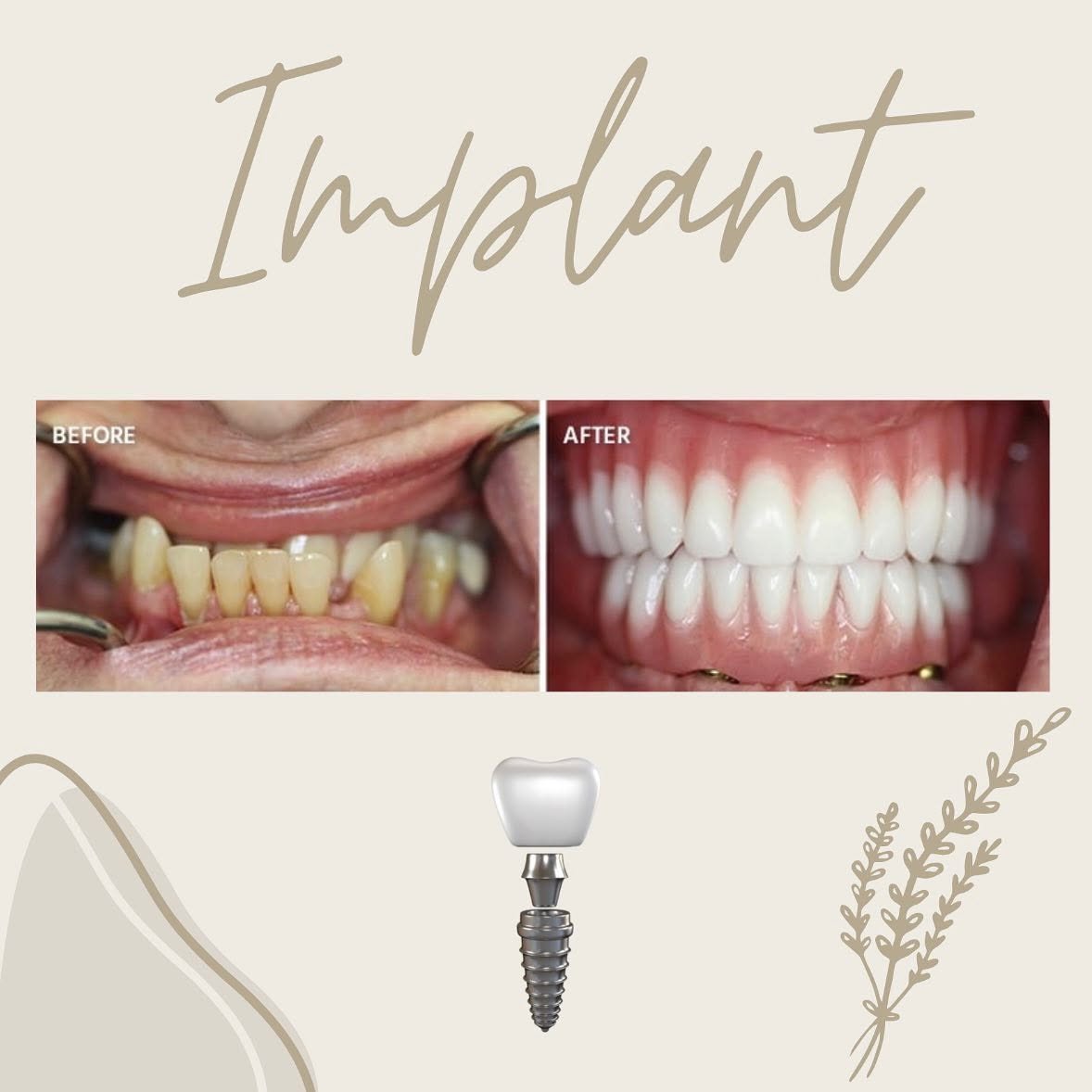 Dental implant before and after smile comparison, case 1