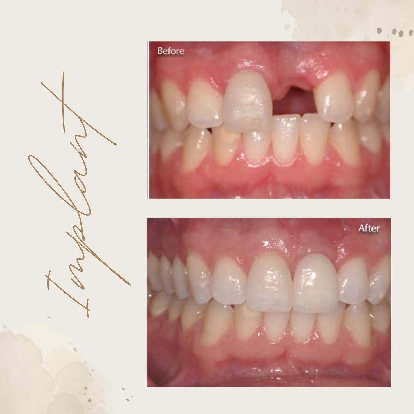 Dental implant before and after smile comparison, case 2