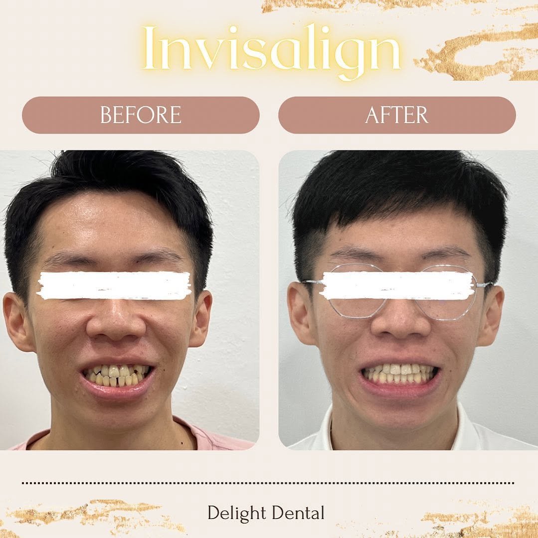 invisalign before after client image 2