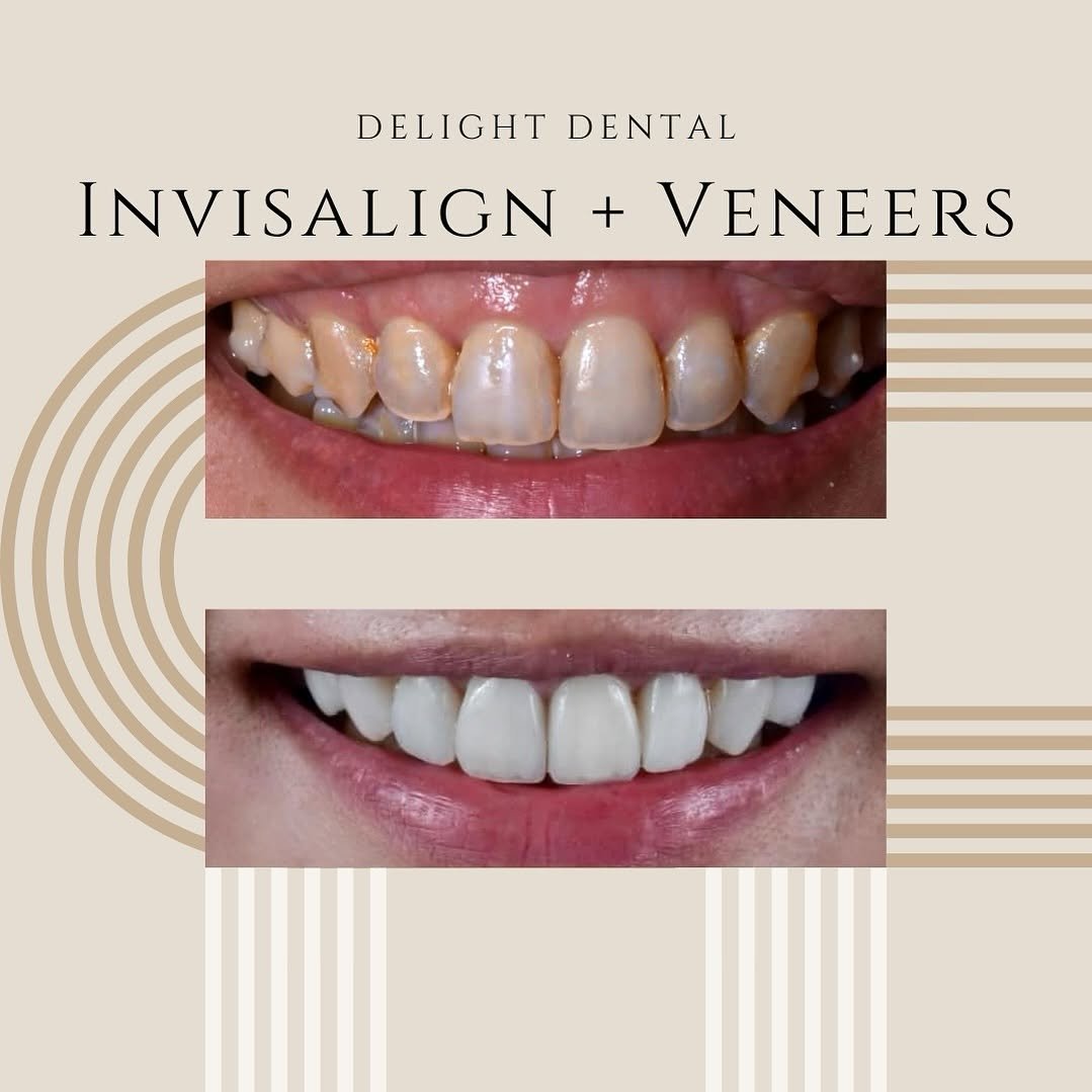 invisalign + venners