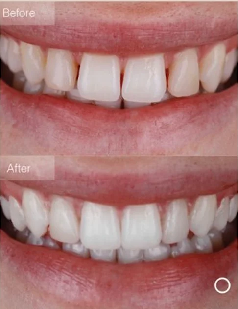 Invisalign Lite treatment package illustration