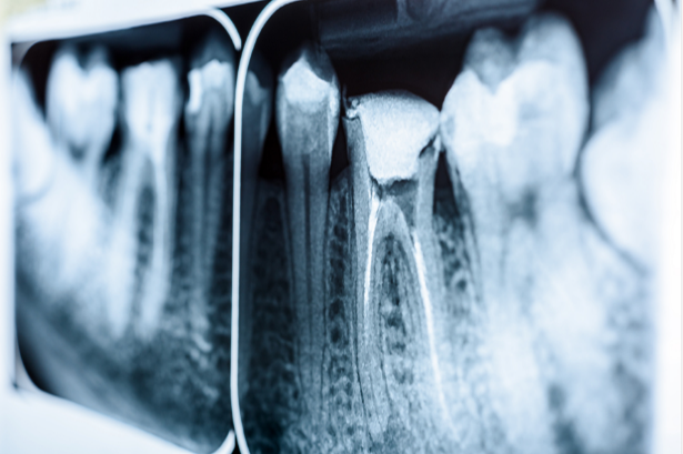 Root Canal Treatment treatment
