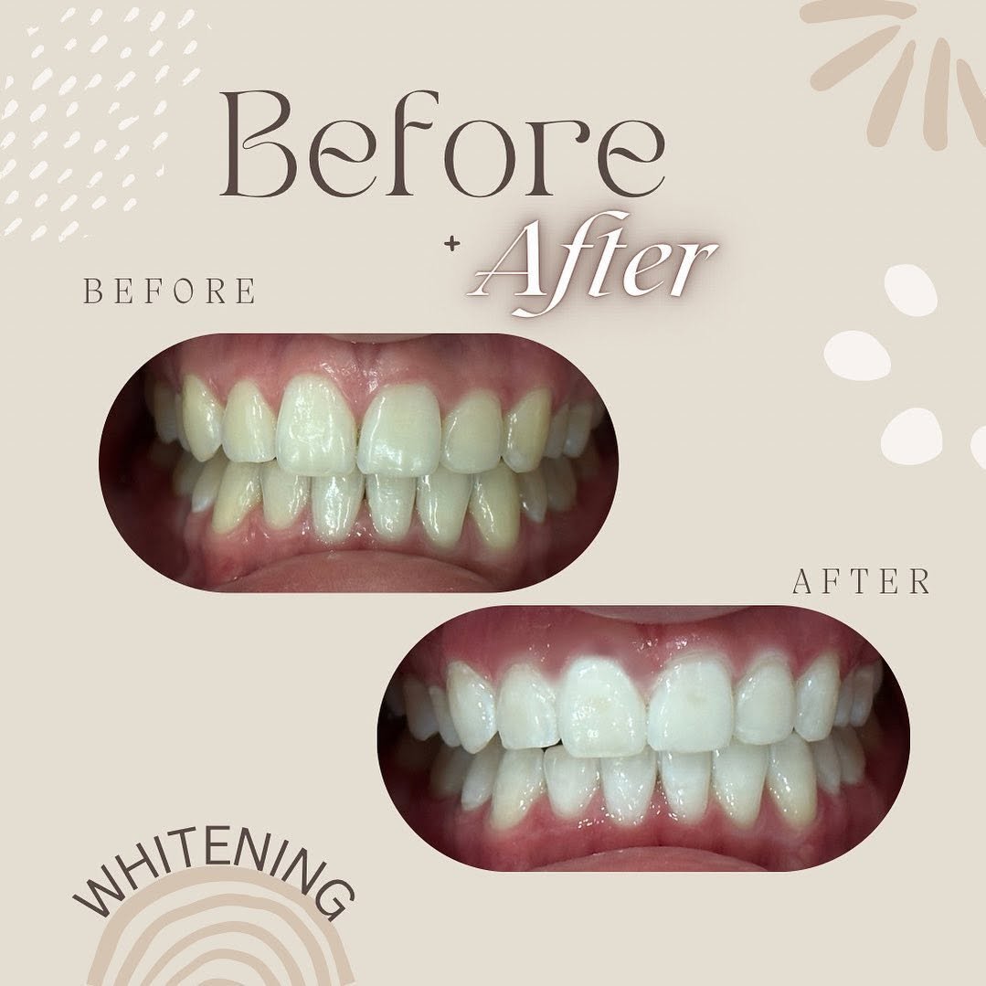 Teeth whitening before and after comparison, case 5