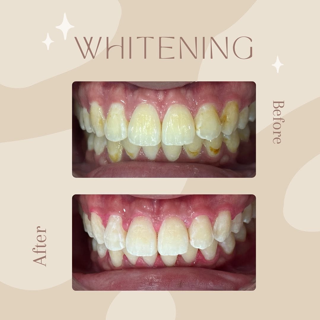 whitening before after 3