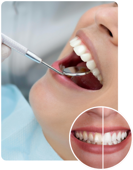 Professional teeth whitening treatment at Delight Dental